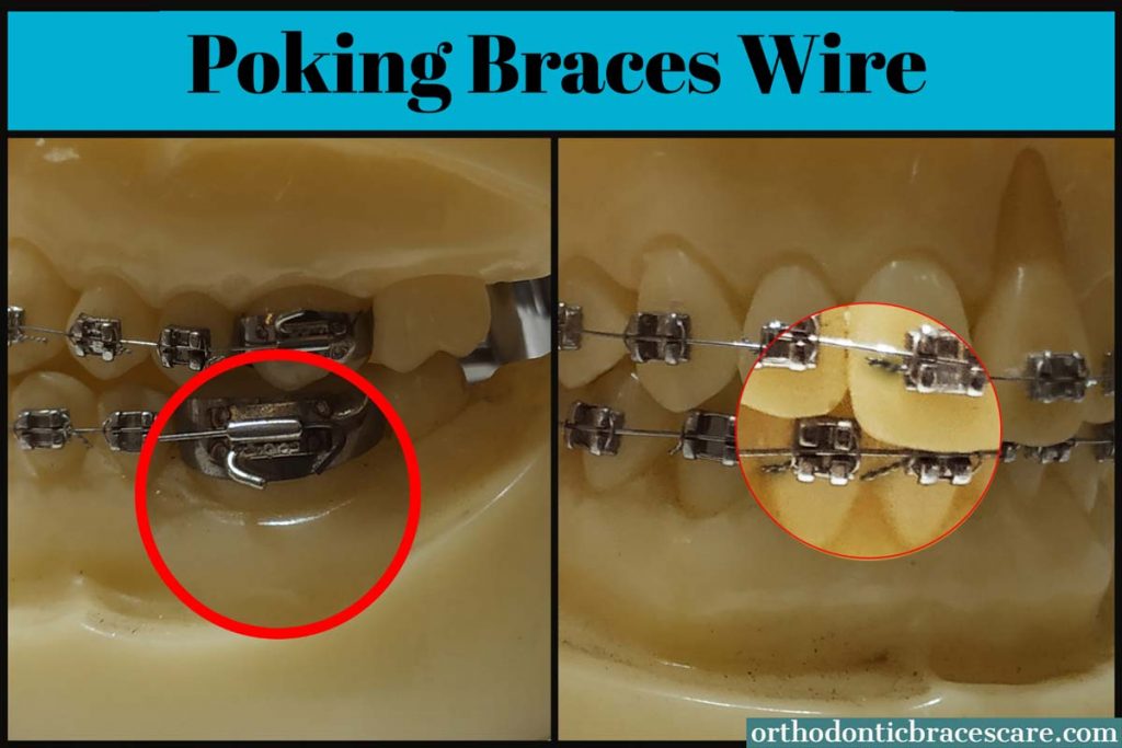 braces wire poking back mouth