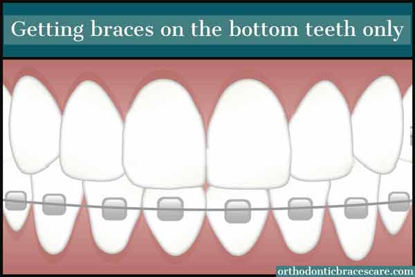 Getting Braces On Bottom Teeth Only