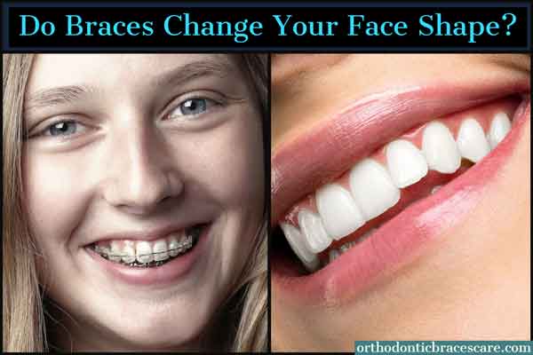 Do Braces Change Your Face Shape