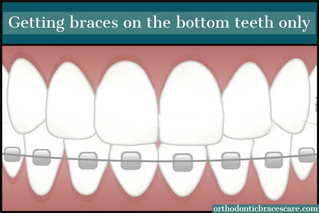 Braces On Bottom Teeth Only