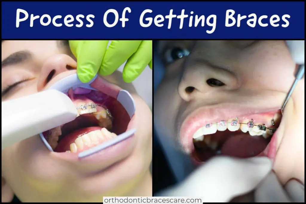 Process Of Getting Braces: Steps with duration