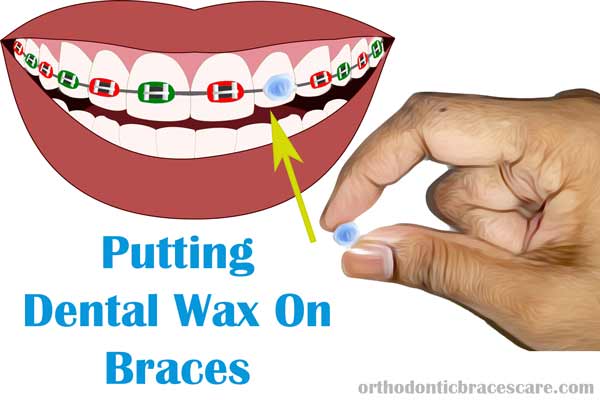 Ways how to put dental wax on braces