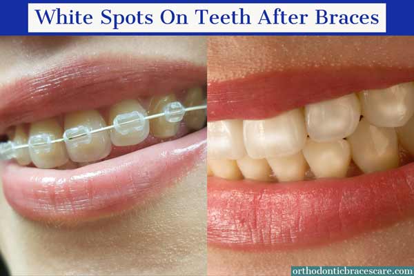 white spot on teeth from braces