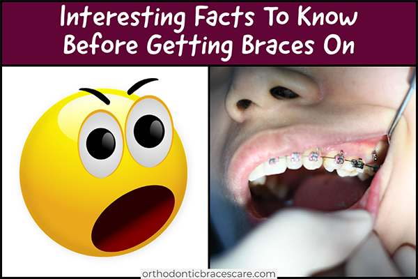 45 Interesting Things To Know Before Getting Braces On