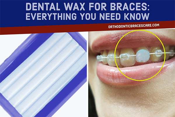 What Is Braces Wax And How To Use It Orthodontic Braces Care