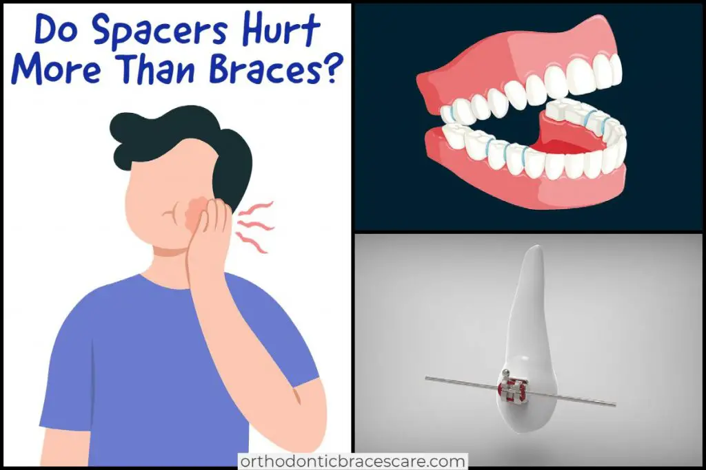 Spacers hurt more than braces