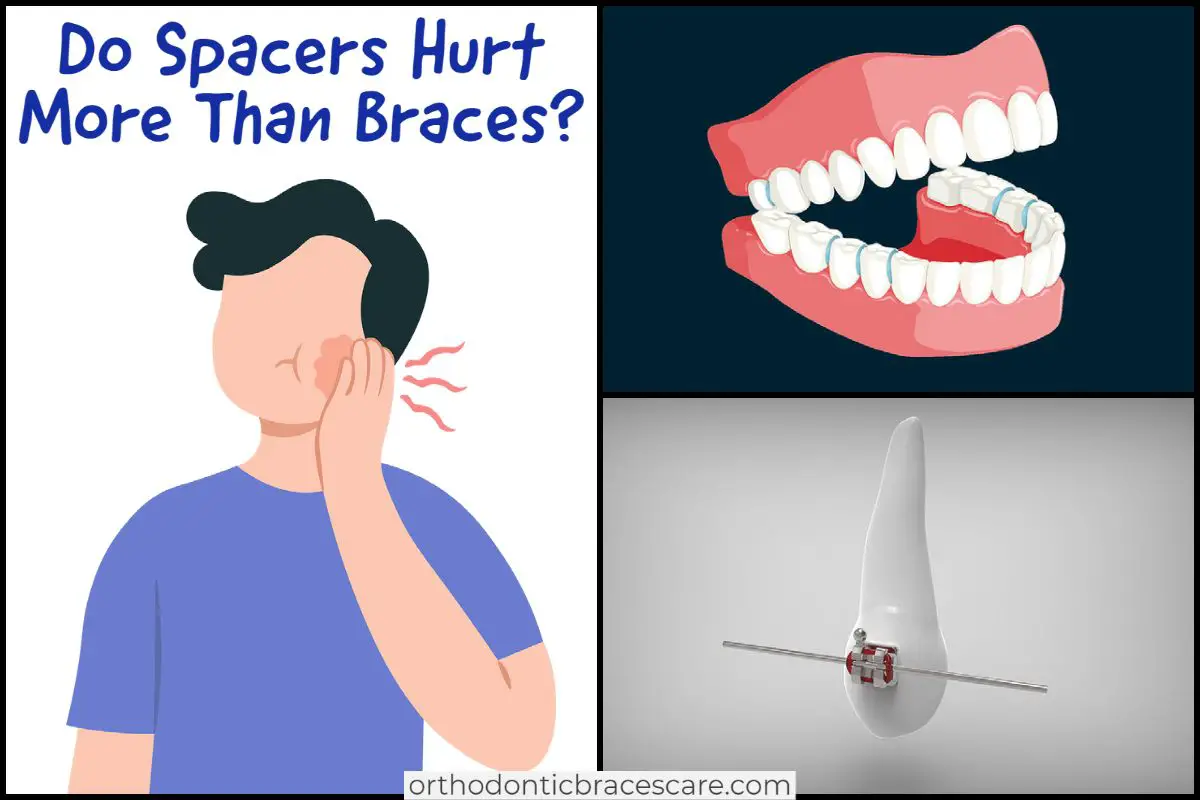 Do spacers hurt
