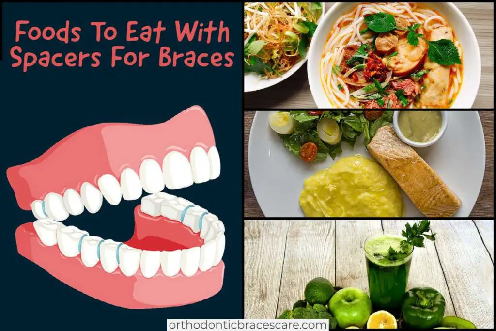 Foods To Eat and Foods To Avoid With Spacers For Braces