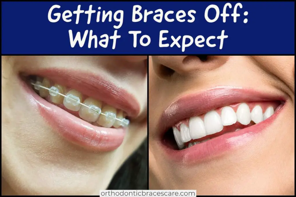 What To Expect When Getting Braces Off - Orthodontic Braces Care