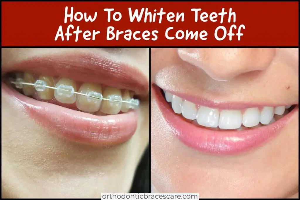 Ways To Whiten Teeth After Braces Come Off