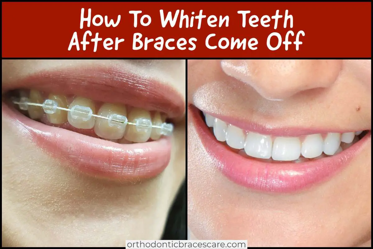How To Whiten Teeth After Braces