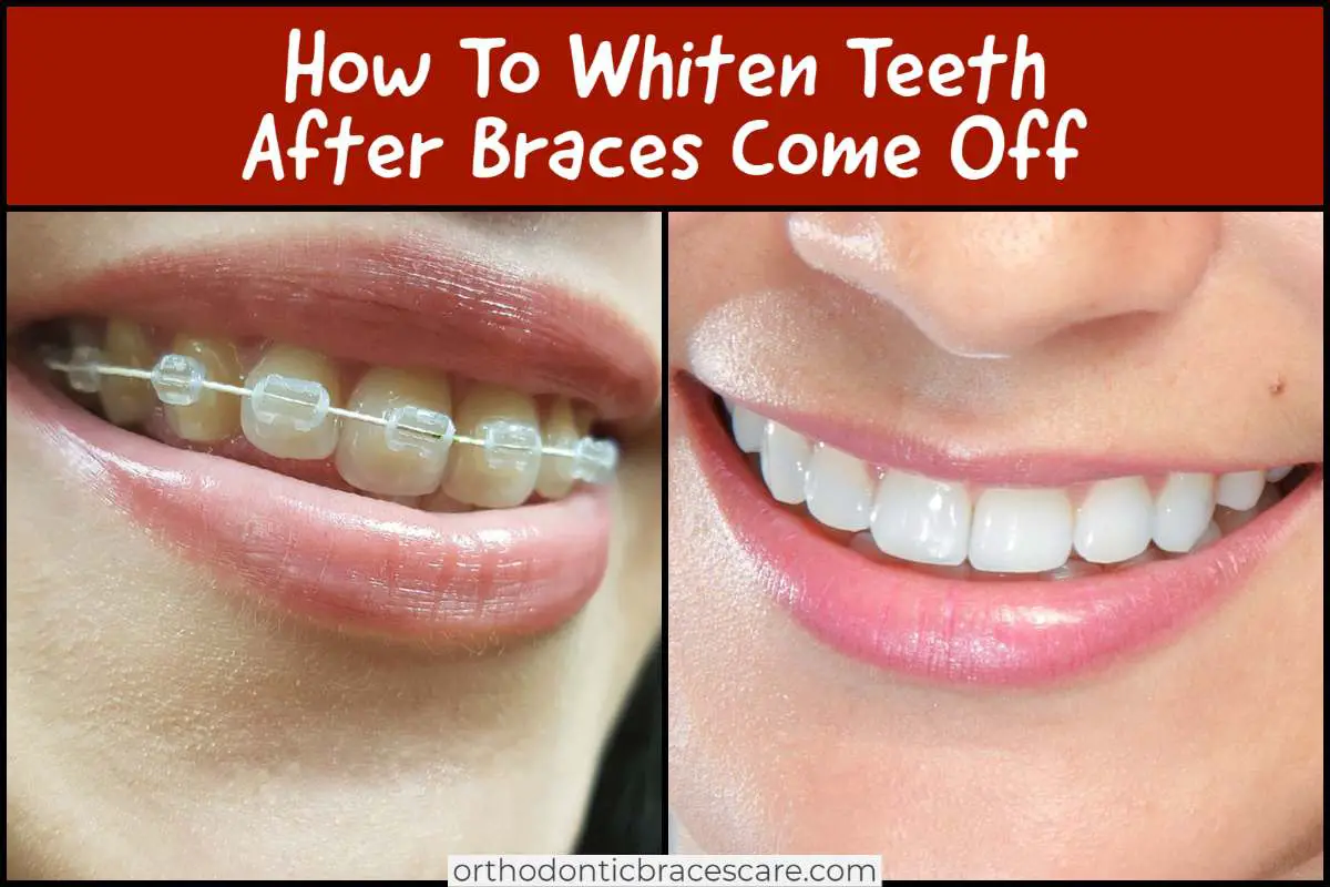 can i use whitening toothpaste with braces