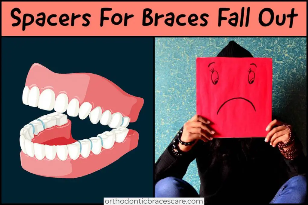 What happens if spacers for braces fall out, how to fix it