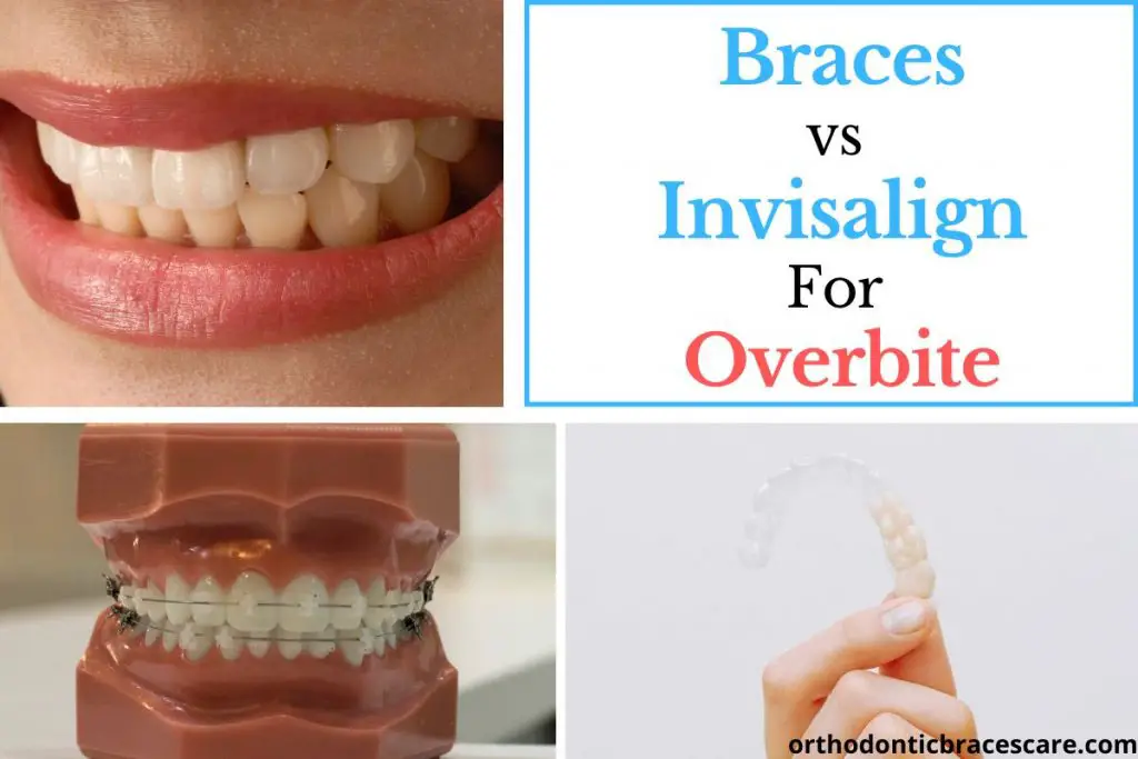 Braces vs Invisalign For An Overbite