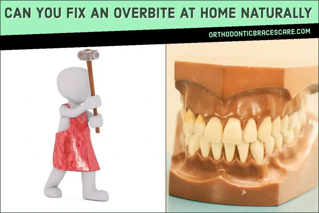 Fixing An Overbite At Home Naturally