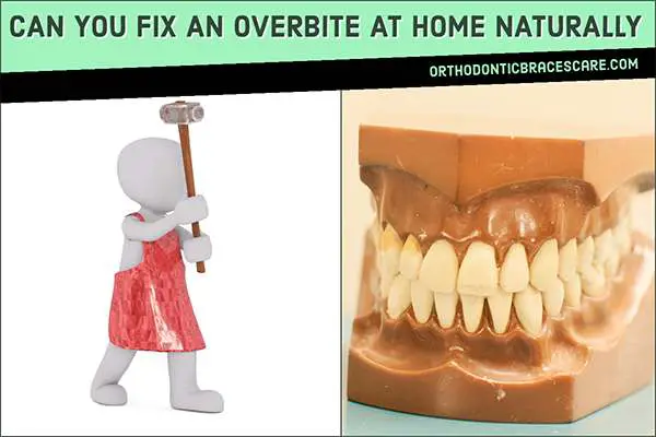 Can You Fix An Overbite At Home Naturally