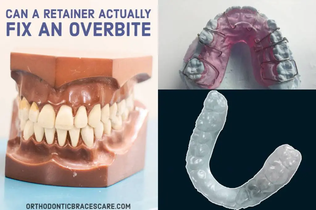 Fixing An Overbite With Retainer