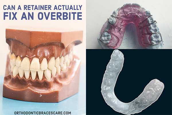 Can A Retainer Actually Fix An Overbite
