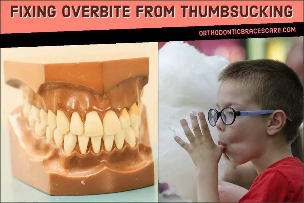 overbite thumbsucking orthodontic erupt persists