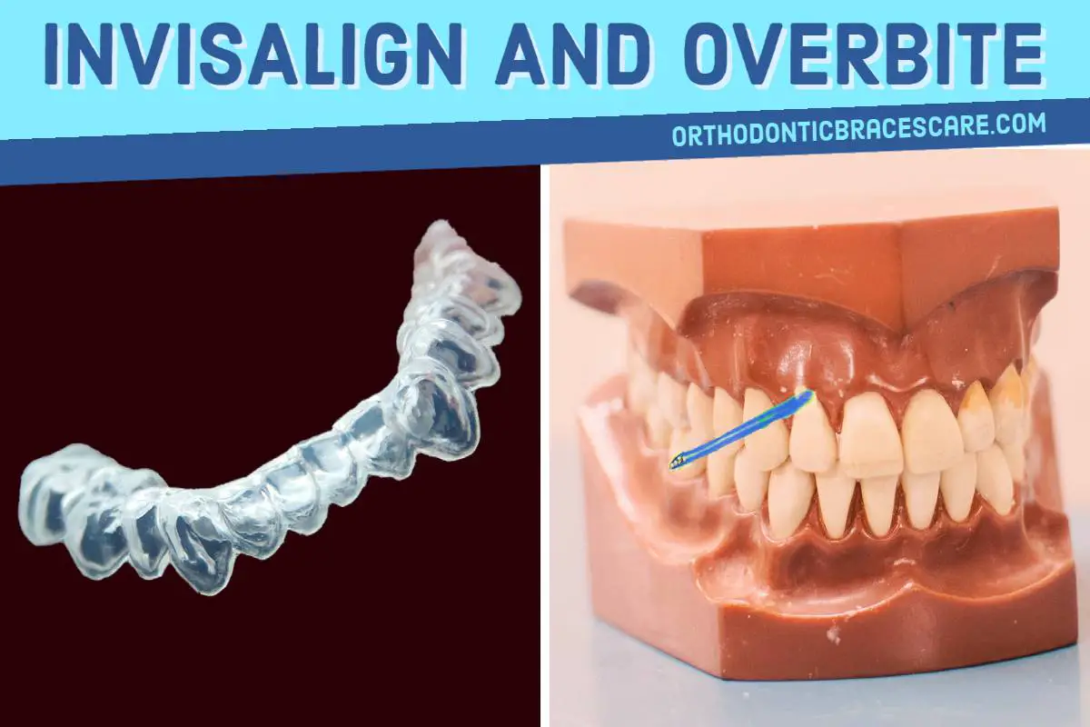 invisalign overbite misaligned orthodontic