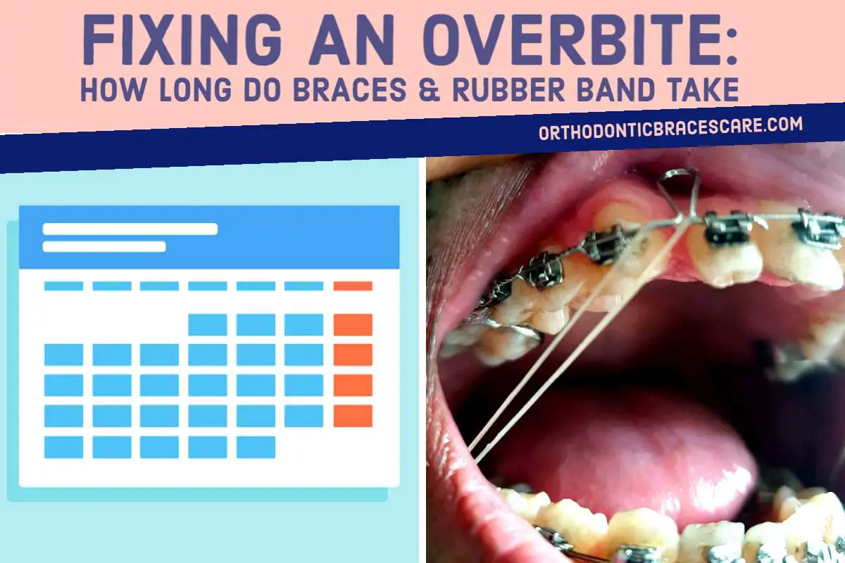 How Long Do Braces And Rubber Band Take To Fix Overbite Orthodontic Braces Care