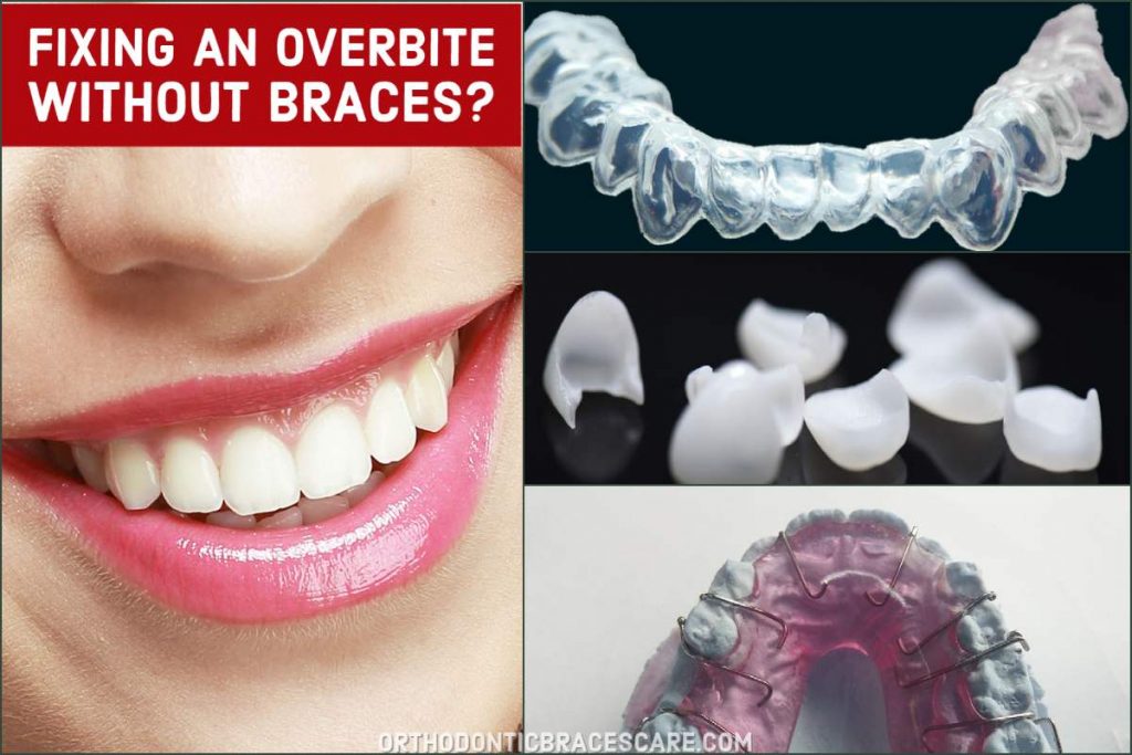 How To Fix An Overbite Without Braces
