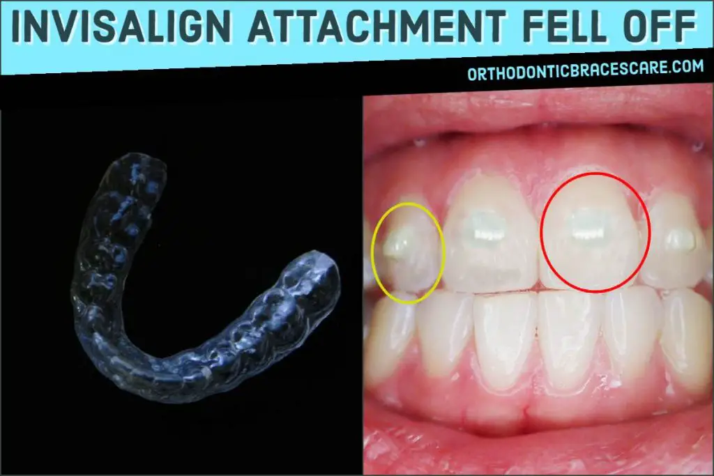 Invisalign Attachment Fell Off: Causes, Ways To Fix