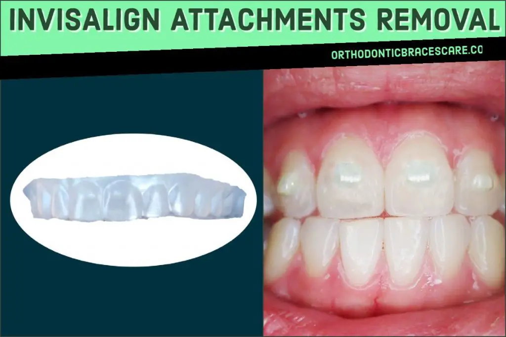 Invisalign attachment removal