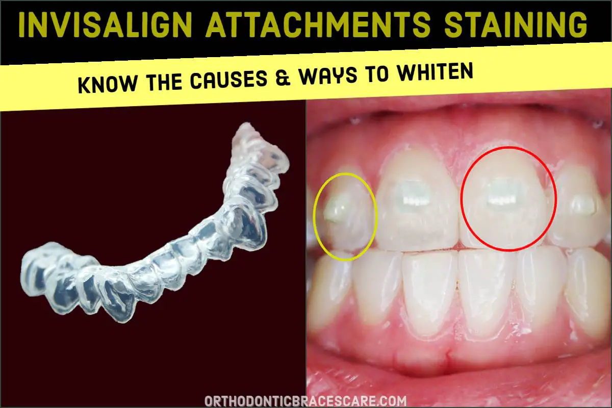 Invisalign Attachments Staining Cleaning And Whitening Orthodontic Braces Care