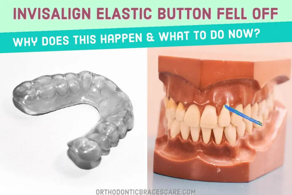 Invisalign elastic buttons fell off: Causes and ways to fix