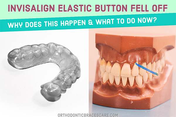 Invisalign elastic buttons fell off: Causes and how to fix