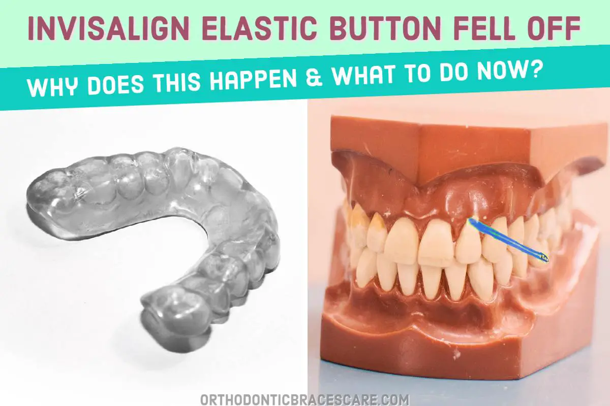 What To Do If Invisalign Elastic Buttons Fell Off | Orthodontic Braces Care