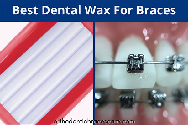 Top dental wax for braces
