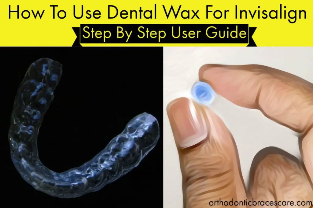 Can You Use Dental Wax On Invisalign