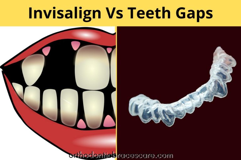 Can Invisalign Close Teeth Gaps [How long it takes] Orthodontic Braces Care