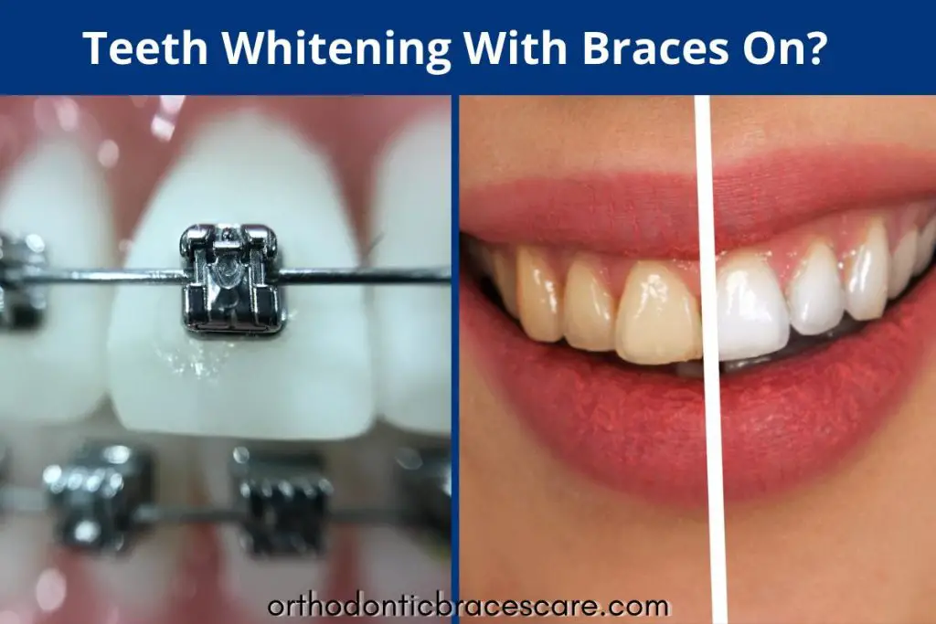 Teeth whitening with braces