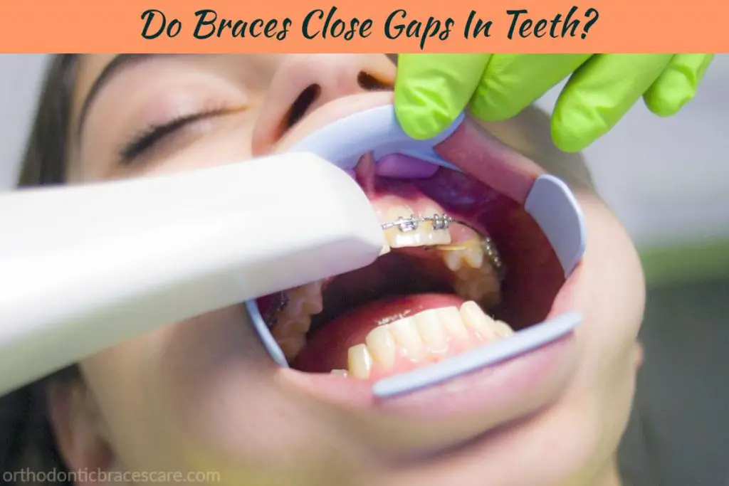Braces close gaps in teeth