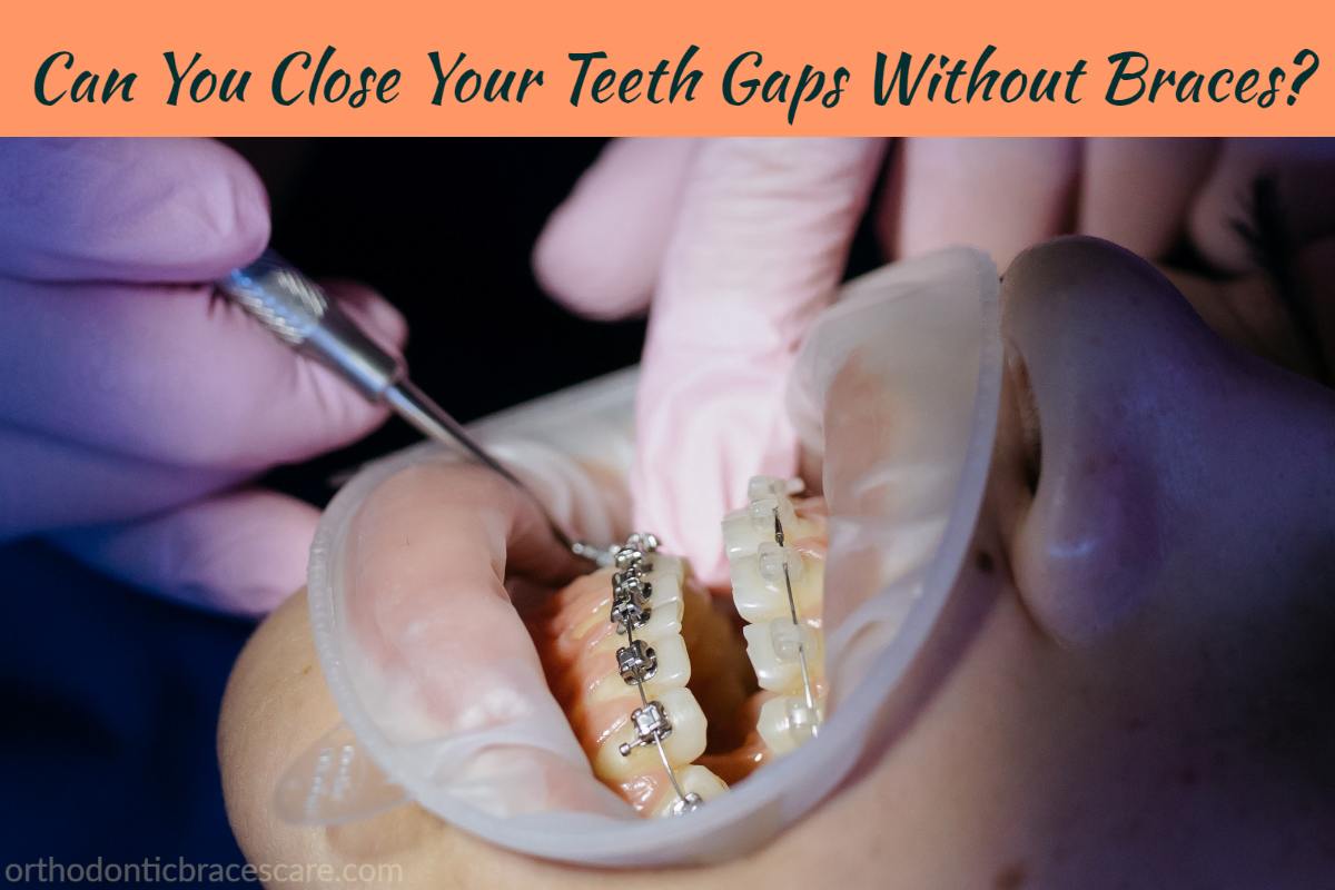 Close teeth gaps without braces