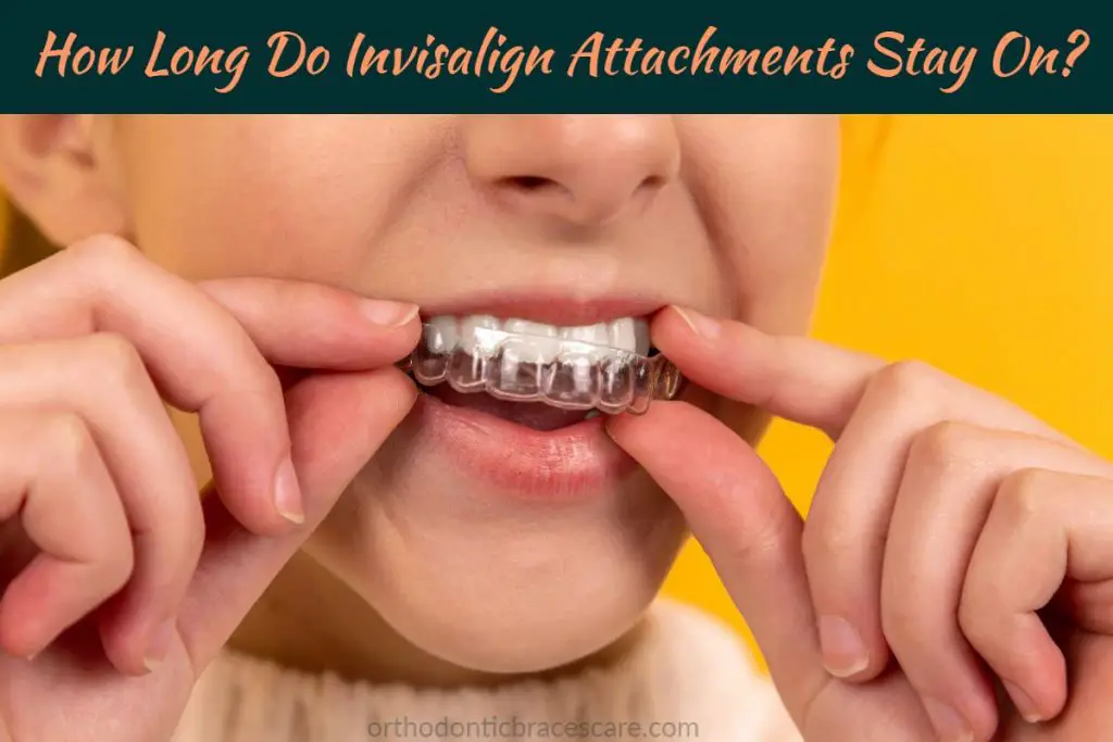 Duration Invisalign Attachments On Teeth