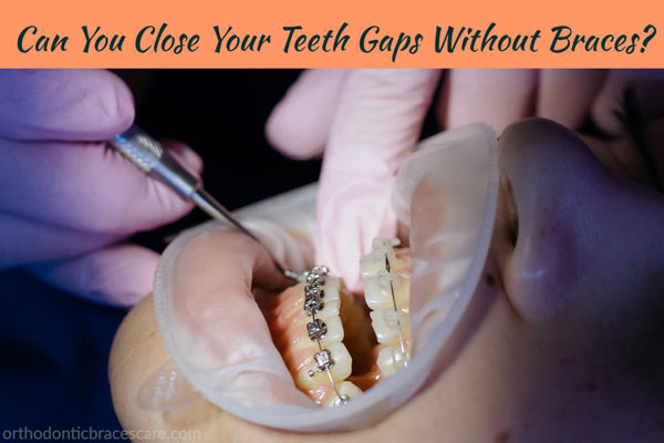 Can You Close Your Teeth Gaps Without Braces?