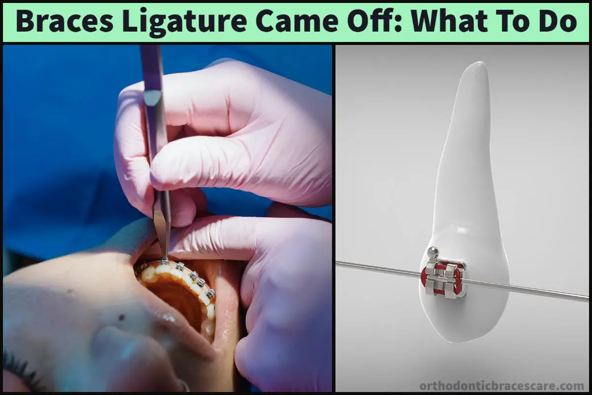 Braces Ligature (Rubber Band) Came Off Causes, What To Do